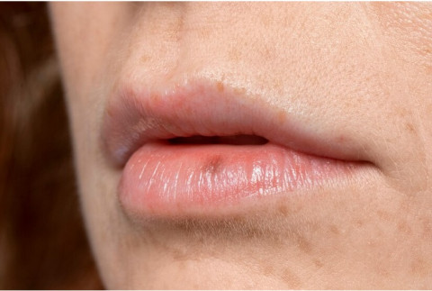 5 Penyebab Flek Hitam di Bibir, Salah Satunya Dehidrasi