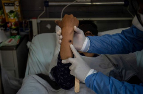 Pakar UGM Ungkap Cara Penularan, Gejala, hingga Pencegahan Mpox