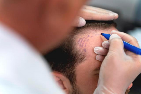 5 Hal yang Perlu Kamu Tahu Sebelum Memilih Klinik Transplantasi Rambut