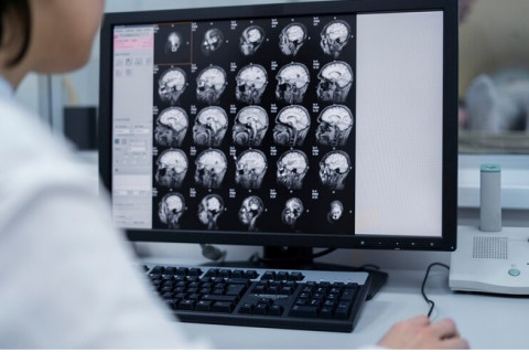 Mengenal Tumor Hipofisis, Gejalanya dari Sakit Kepala hingga Mengalami Kebutaan