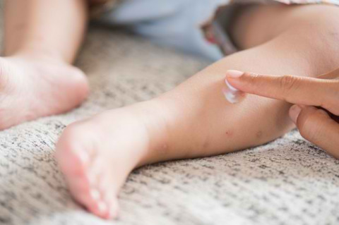 Bunda Wajib Tahu, Ini 7 Cara Menghilangkan Bekas Gigitan Nyamuk pada Bayi