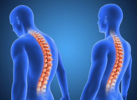 Bukan Hanya di Otak, Stroke Juga Bisa Terjadi di Sumsum Tulang Belakang!