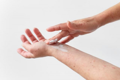 Dokter bagi Cara Hadapi Rasa Gatal Dermatitis Atopik yang Kambuh
