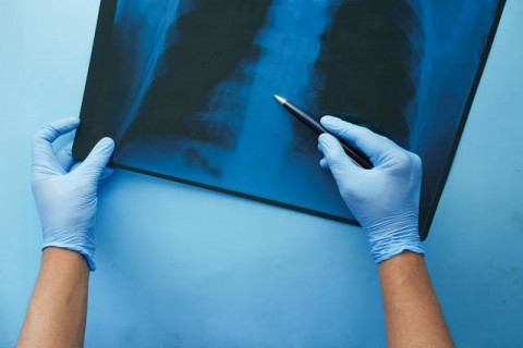 Apa Itu Legionnaires? Penyakit yang Lagi Banyak Terjadi di New York City