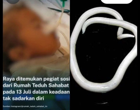 Terdapat Lebih 1 Kg Cacing di Tubuh, Balita 4 Tahun di Sukabumi Tewas