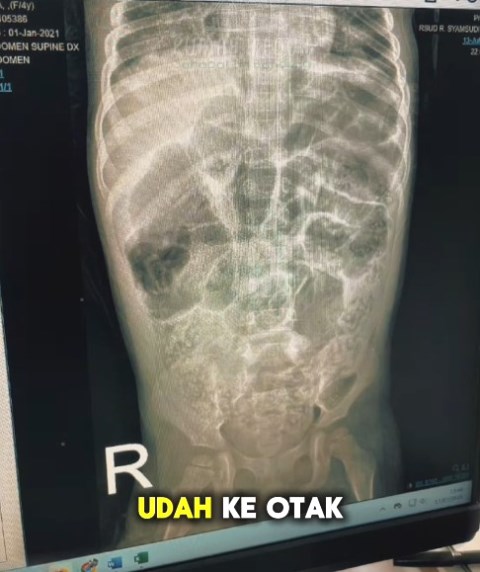 Irma Prihatin Balita di Sukabumi Meninggal dalam Kondisi Penuh Cacing