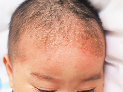 Cara Aman Mengatasi Cradle Cap pada Bayi dengan Minyak Alami