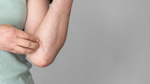3 Berita Terpopuler Gaya: Kulit Gatal Hingga Demam pada Bayi dan Anak