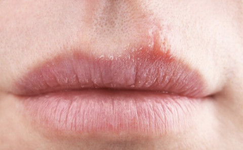 Simak! 5 Cara Terbaik Mengobati Luka Herpes Mulut