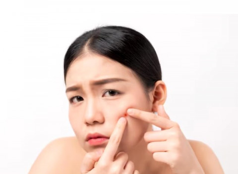 4 Cara Hilangkan Bopeng Bekas Jerawat