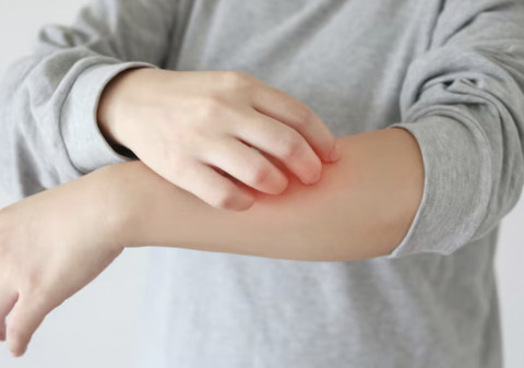 Mandi Setiap Hari ternyata Aman untuk Penderita Eksem, Ini Syaratnya!