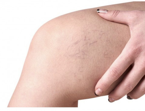 Mengapa Varises Sering Muncul Saat Kehamilan? Ini Penjelasannya