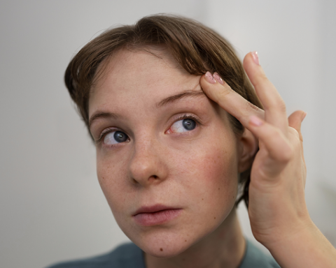 Jerawat di Alis Sangat Mengganggu? Ketahui Penyebab dan Cara Mengatasinya