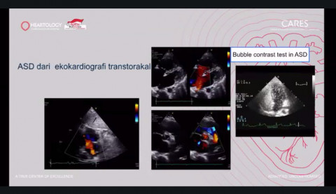 Heartology Catat Keberhasilan Tindakan Operasi MICS dengan Kombinasi ASD Closure dan 2 Valve-Repair