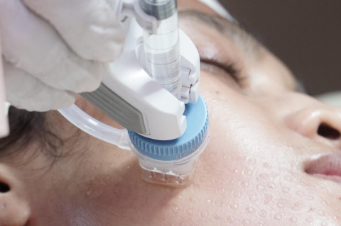 ​Remee Pro Diperkenalkan untuk Mendukung Prosedur Skinbooster