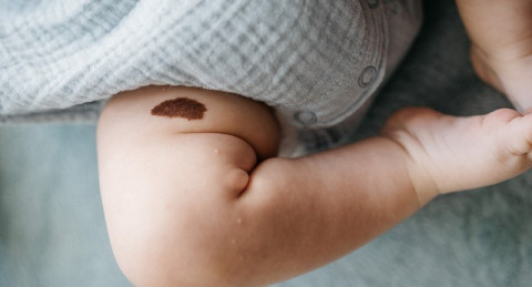 Mystery Solved: Kupas Tuntas Macam-macam Tanda Lahir di Si Kecil