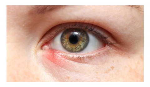 Hordeolum 101: Fakta Bintitan yang Wajib Kamu Tahu Biar Gak Makin Parah