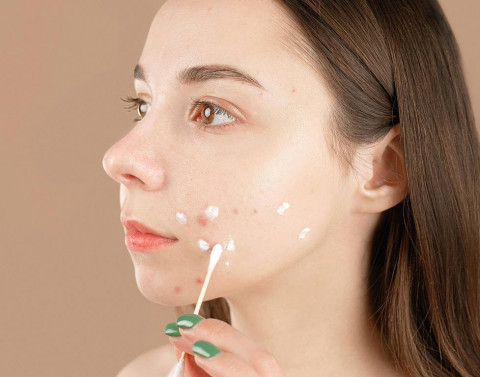 3 Berita Terpopuler Gaya: Jerawat Hormon Hingga Aturan Pencantuman Label Gizi