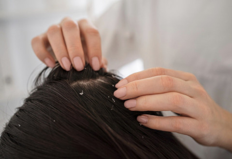 Ketombe Tanda Rambut Kotor? Dokter Tebas Hoaks Ini dan Bagi Cara 'Usir'nya!