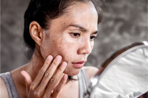 Stop Biarkan Muka Panen Flek! Ini 5 Cara Ampuh Hempas Dark Spot Membandel
