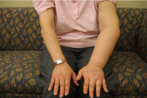 Jangan Sepelekan Bengkak yang Tak Kunjung Hilang, Bisa Jadi Limfedema