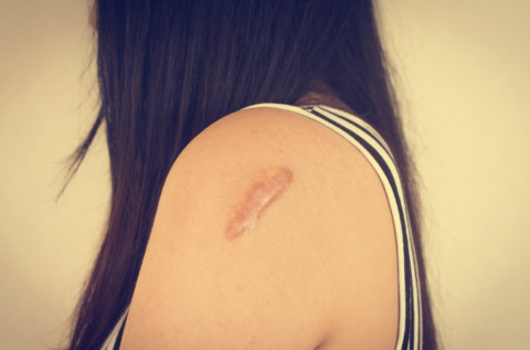 Bukan Sekadar Bekas Luka, Ini Fakta tentang Keloid yang Perlu Kamu Tahu