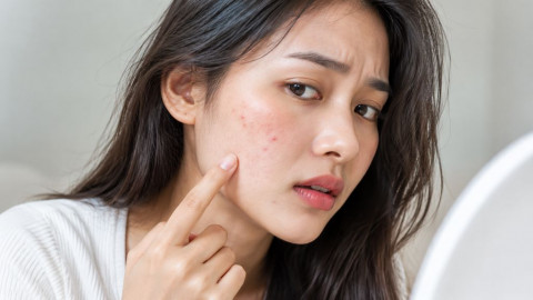 Jerawat di Pipi Susah Hilang? Begini Cara Mengatasinya!