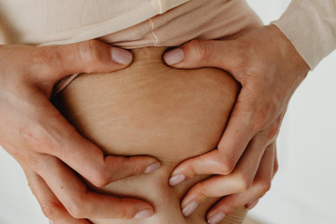 Ketahui Alasan Penyebab Stretch Mark Muncul