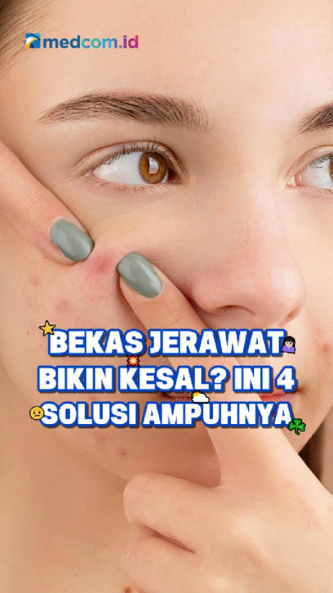 Bekas Jerawat Bikin Kesal? Ini 4 Solusi Ampuhnya