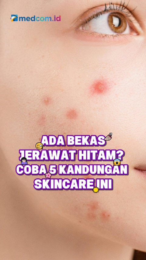 Ada Bekas Jerawat Hitam? Coba 5 Kandungan Skincare Ini