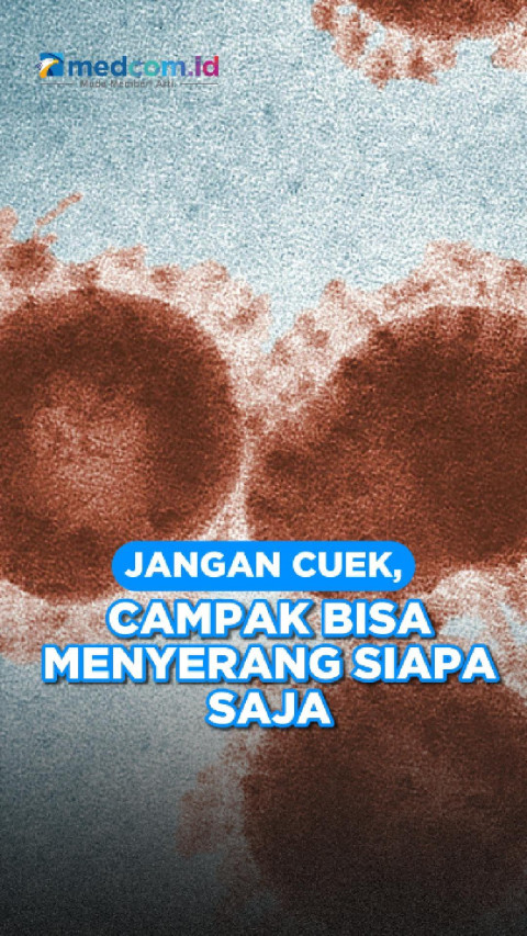 Jangan Cuek, Campak Bisa Menyerang Siapa Saja