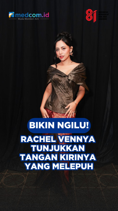 Bikin Ngilu! Rachel Vennya Tunjukkan Tangan Kirinya yang Melepuh