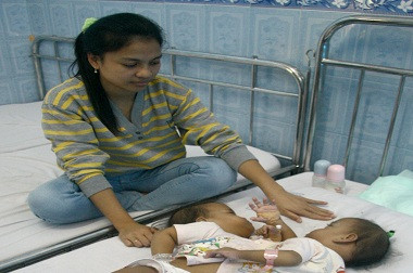 Operasi Pemisahan Bayi Kembar Siam Nurul-Rahma Berhasil