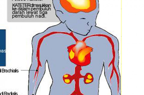 Bagaimana penyakit jantung koroner bisa terjadi
