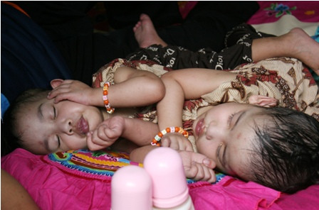 Kondisi Bayi Kembar Siam Syahrina dan Syahrini Terus Membaik 