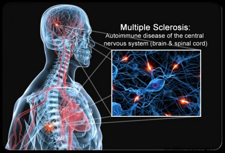 Mengenal Penyakit Multiple Sclerosis yang Diderita Pepeng