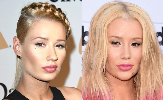Iggy Azalea Operasi Dagu & Hidung?