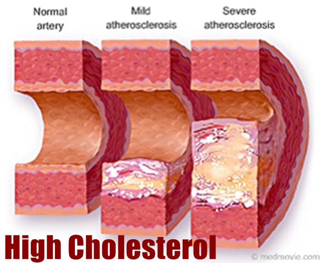 Mitos yang Salah tentang Kolesterol