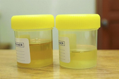 Warna urine menjadi kuning karena adanya