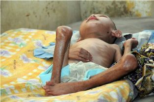 Jatim Peringkat Kedua Penderita Gizi Buruk di Indonesia