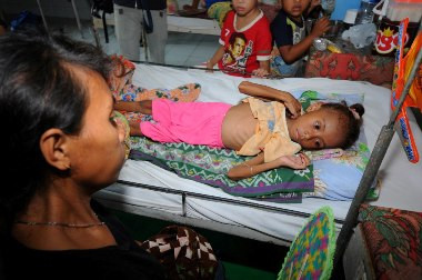 Kasus Gizi Buruk Masih Hantui Sumut 