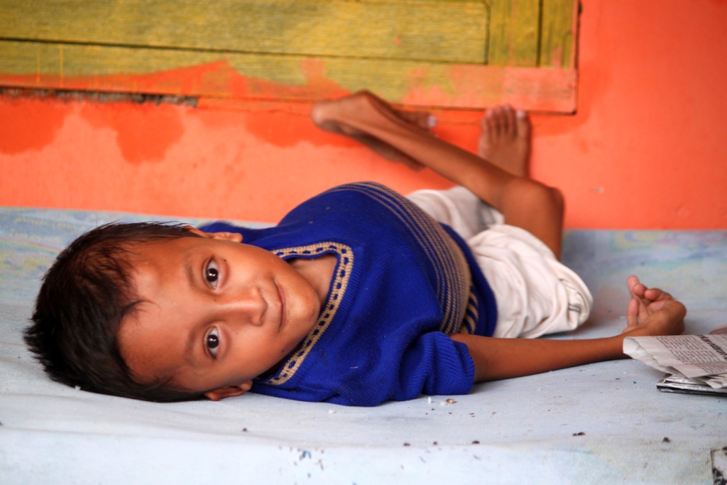 Penderita gizi buruk. (MI/Bary Fathahilah)