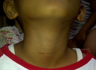 Leher Bocah SD Dicekik Tambang oleh Temannya