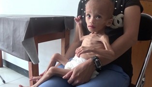 Usia 2 Tahun, Bocah Ini Hanya Berbobot 4,5 Kg