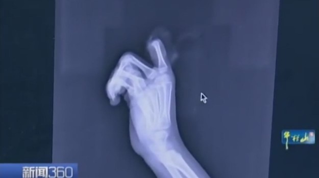 Dimarahi Orangtua Gara-Gara Game, Anak Ini Berontak dan Potong Jarinya