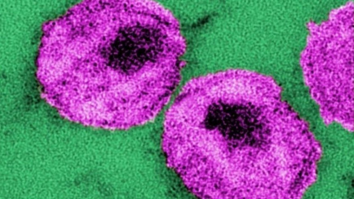 Peneliti Optimistis Obat HIV/AIDS Ditemukan 3 Tahun Lagi