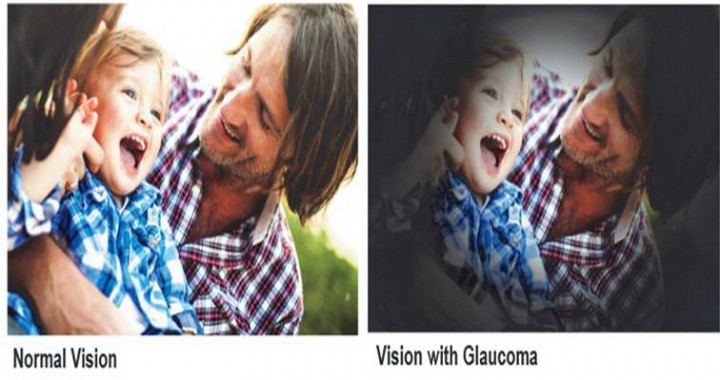 Waspadai Glaukoma, Si 'Pencuri' Penglihatan