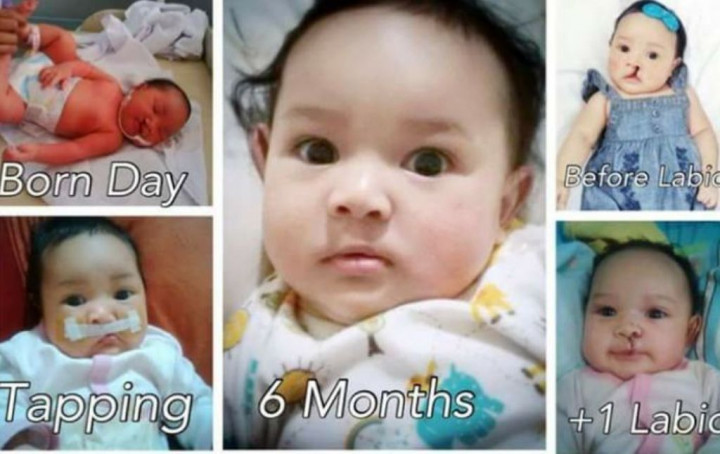 Melahirkan Bayi dengan CBL, Kami Semakin Solid