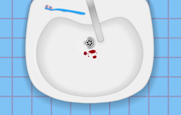 5 Penyebab Gusi Berdarah