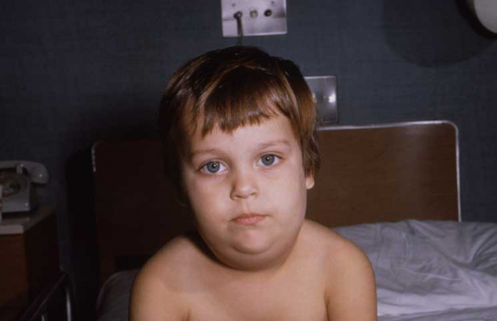 Bahan Alami Penyembuh Gondok